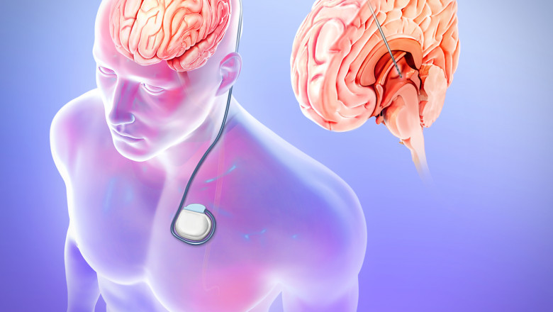 A study of the global Vagus Nerve Stimulators Market: trends, market size, growth, opportunity, as well as forecasts for 2022-2030