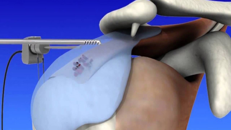 Best searching shoulder arthroscopy surgery in India