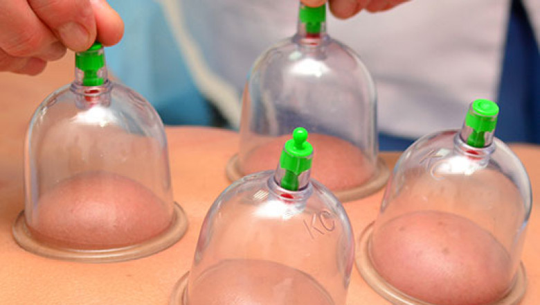 Cupping Therapy: The Best Pain Relief Therapy