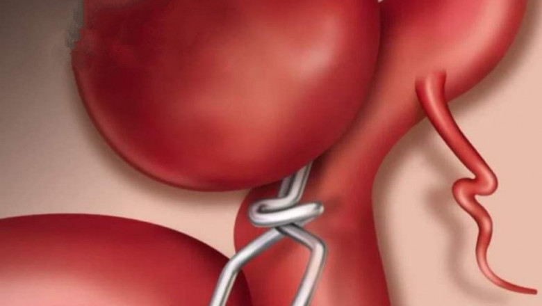 Global Aneurysm Clips Market: Trends, Size, Growth, Opportunity, and Forecast to 2026