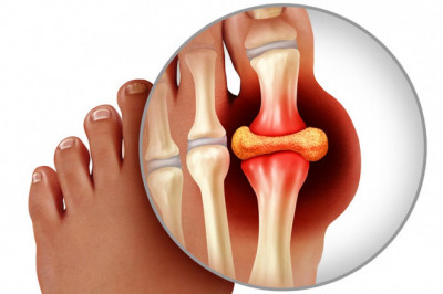 Gout Therapeutics Market Size, Share, Regional Overview and Global Forecast to 2028