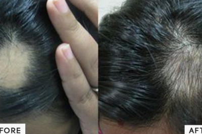 Hair Loss: Myths, Causes and Treatments