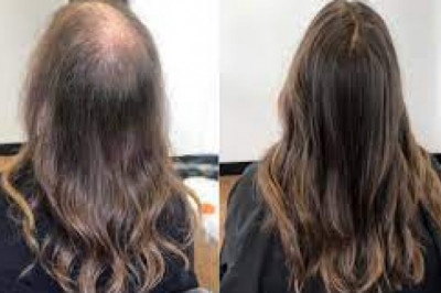 Hair loss treatment Queen Street East Toronto