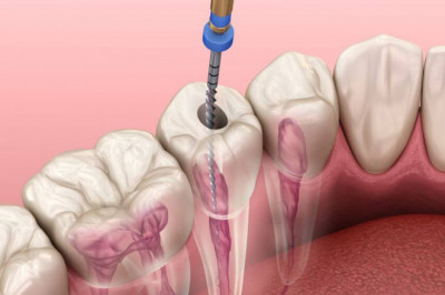 Root Canal Treatment in North York