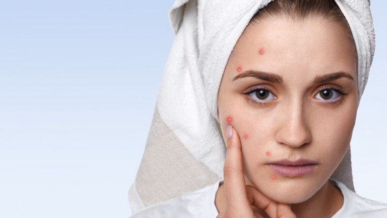Homeopathy Treatment for Acne