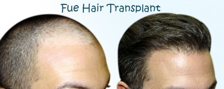 Best Hair Transplant Clinic in Bangalore