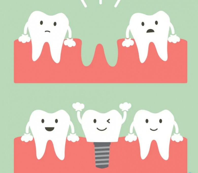 Dental Implants