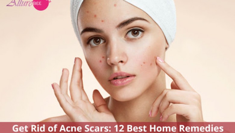 Get Rid of Acne Scars: Best Home Remedies For Acne Scar