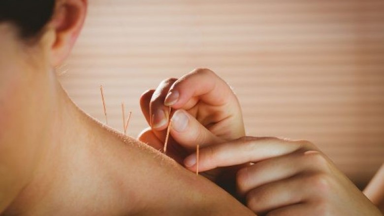 Acupuncture treatment  | Acupuncture therapy  | Acupuncture for anxiety
