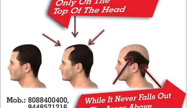 Hair Transplant in Bangalore | Hair Transplant Cost in Bangalore