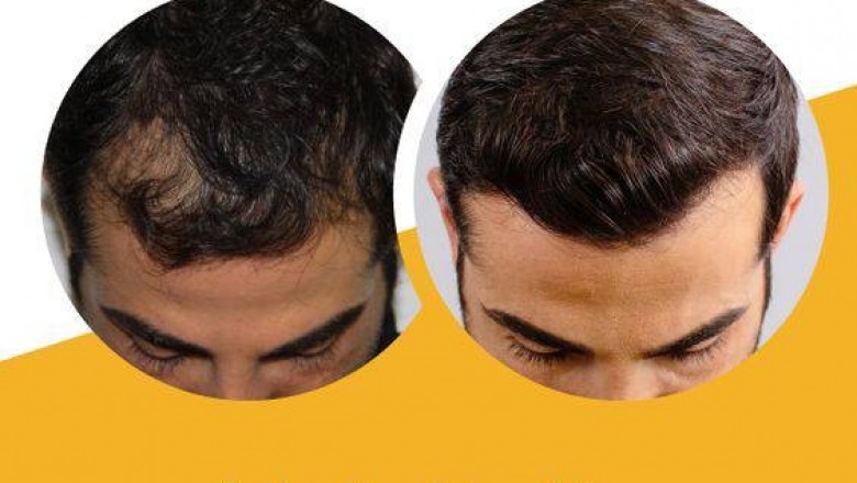 Will That Hair Transplant Really Make Your Hair Grow?