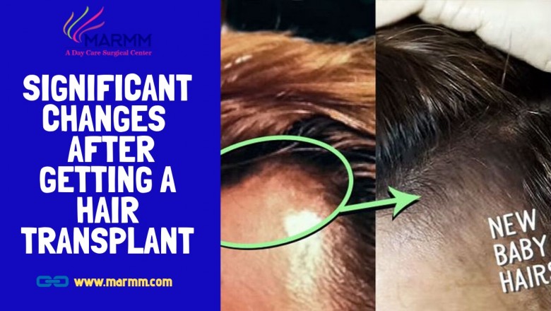 What Happens just After a Hair Transplant?