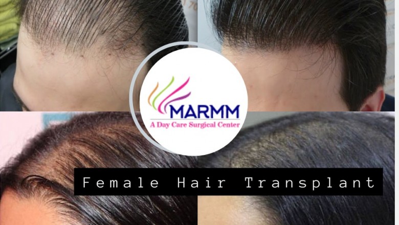 What Is The Best Way Of Undergoing Hair Transplant Surgery?