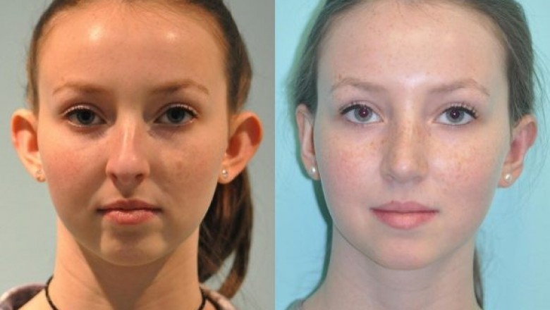Change the Look of Ears with Pinnaplasty Treatment | Signature Clinic
