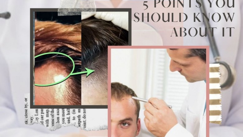 Top 5 Questions you must ask your Hair Doctor before starting any Hair Treatment in Indore?
