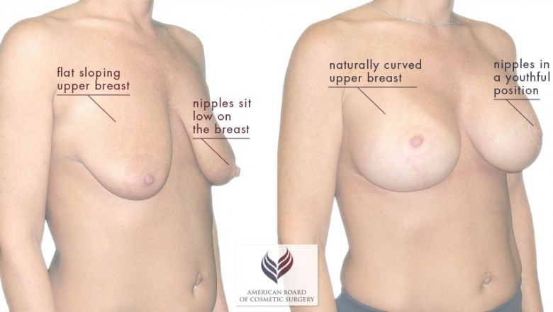 Breast Lift Surgery In Lucknow