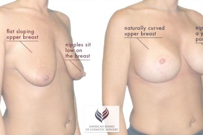 Breast Lift Surgery In Lucknow