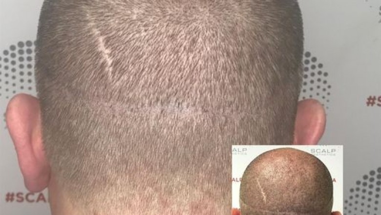 Is Microblading Eyebrows Worth It?