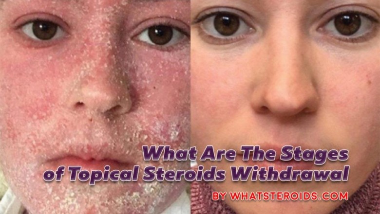What are The Stages of Topical Steroids