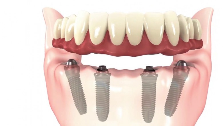 What to Expect In the course of Dental Implant Treatment