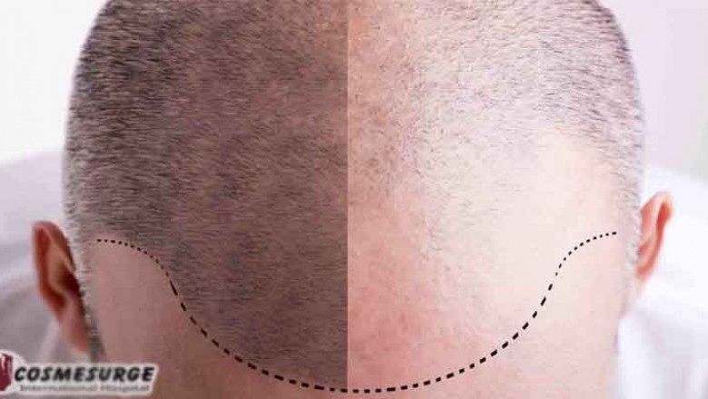 best hair transplant clinic in islamabad