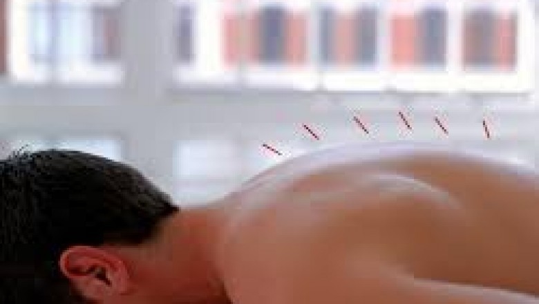 Expert Acupuncture in Auckland | AcuPhysioHealth