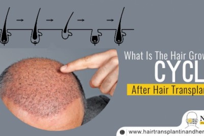 What Is The Hair Growth Circle After Hair Transplant?