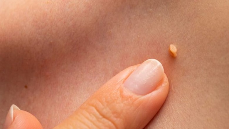 Human Papilloma Virus Symptoms