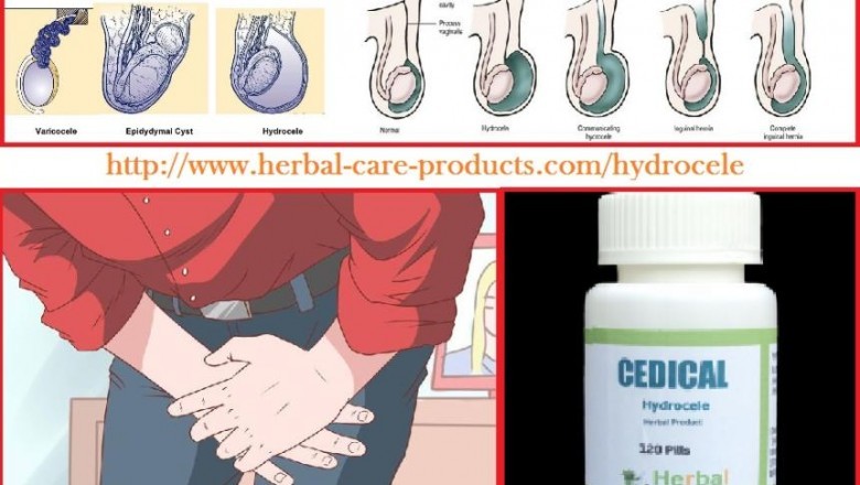 Hydrocele Treatment and Symptoms Causes Details