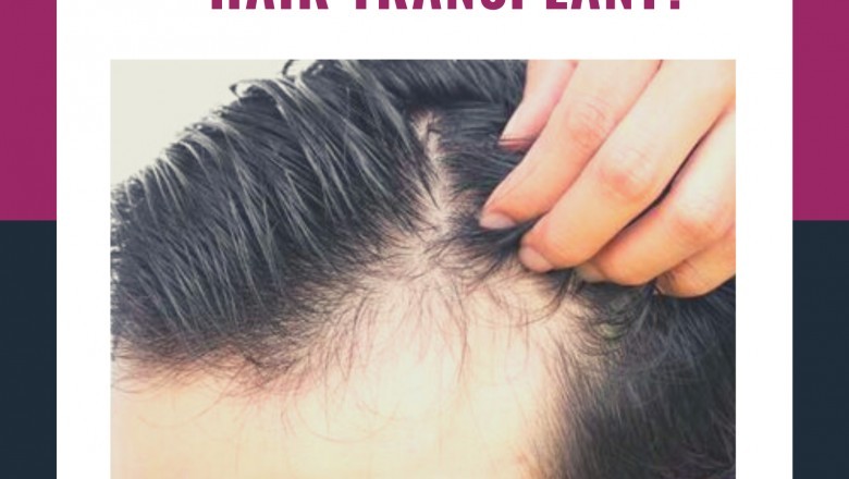 Can we Have The Exact Match Of Original Hair Colour With The Hair Transplant?