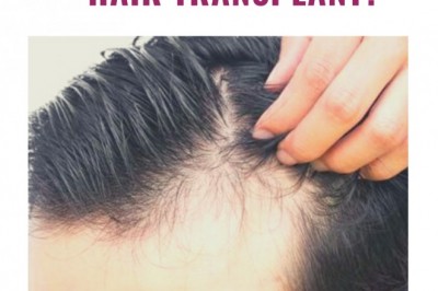 Can we Have The Exact Match Of Original Hair Colour With The Hair Transplant?