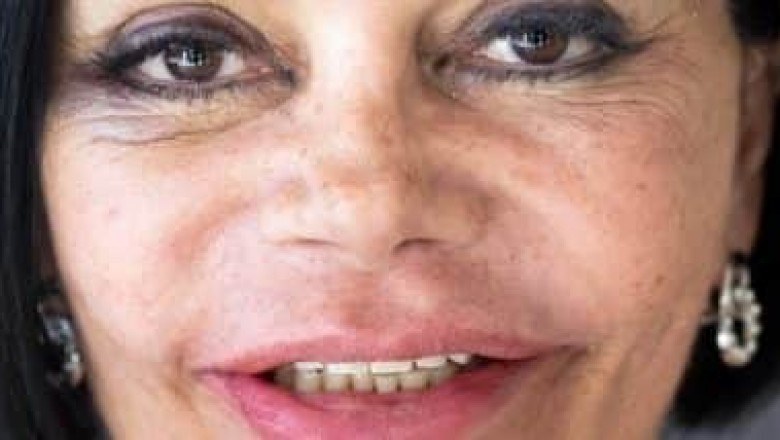 Implantes zigomáticos e reabilitação dentária completa ZAGA