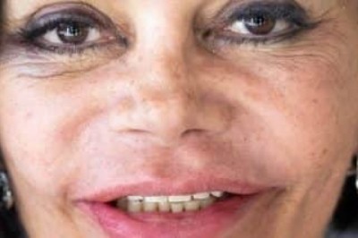 Implantes zigomáticos e reabilitação dentária completa ZAGA