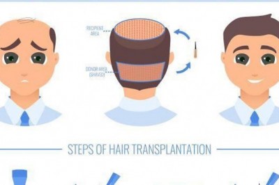 Technique Vs Cost Perspective of Choosing The Hair Transplant Procedure