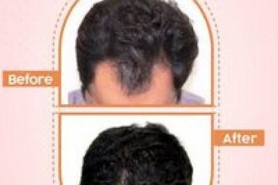 Dealing with bald scalp: How To Restore It?