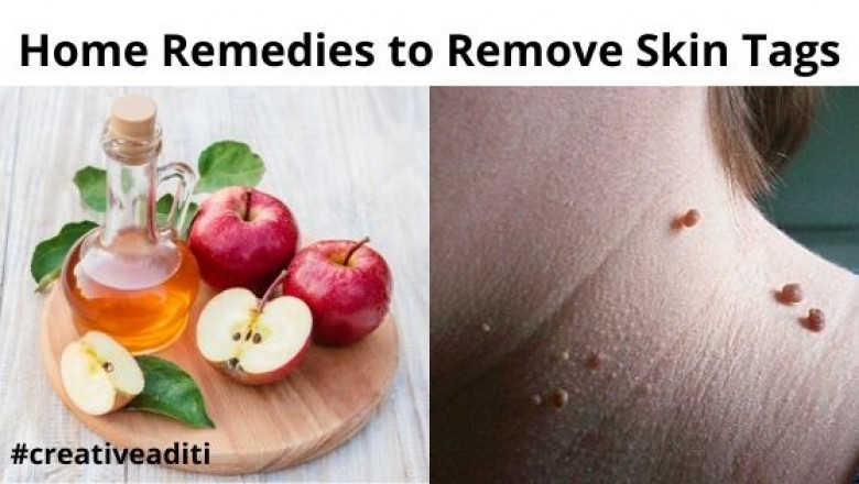 Skin Tags Removal