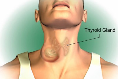 Thyroid Cancer: Symptoms, Causes and Treatment
