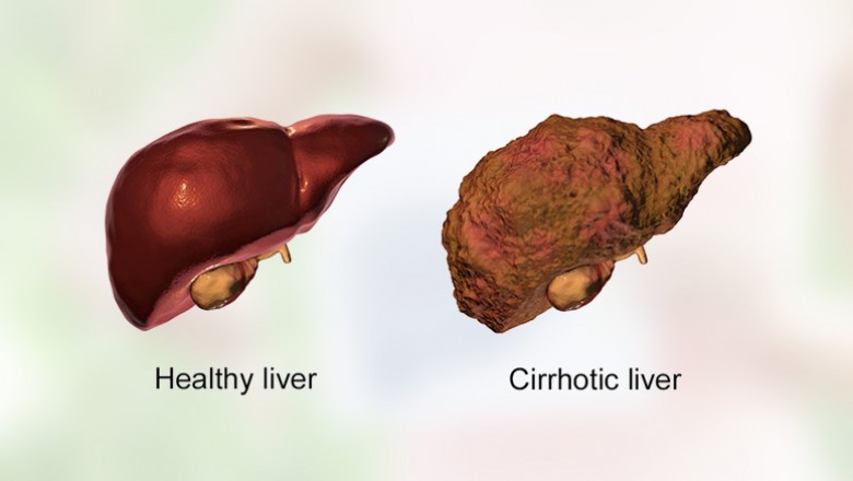 Cirrhosis of Liver