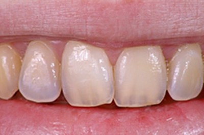 Tooth Erosion | Urgent Dental Care New York