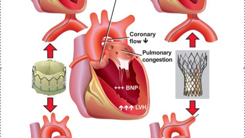 TAVI Market is poised to grow at a CAGR of 14.5% during the forecast period of 2020-2030