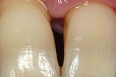 Periodontitis | Severe Gum Disease | Emergency Dental Service in Orange