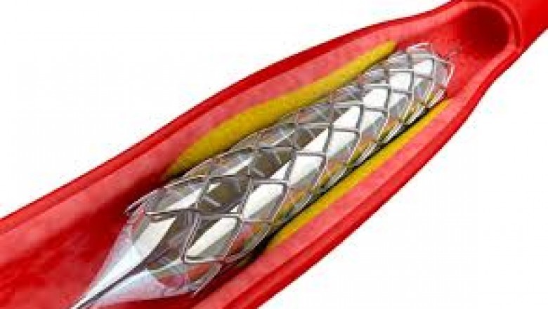 Global Bioabsorbable Stents Market Trends, Size, Forecast - 2018-2023
