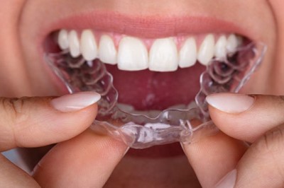 The Advantages of Invisalign over Traditional Metal Braces