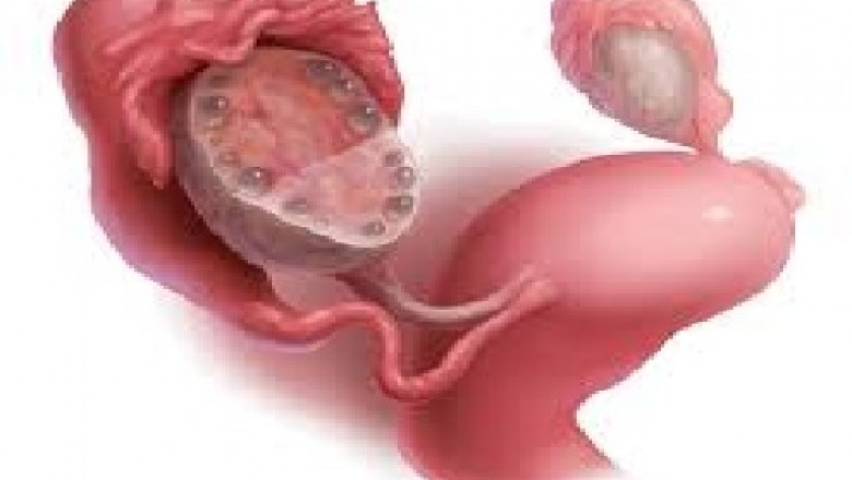 Global Polycystic Ovary Syndrome Market Trends, Size, Forecast - 2018-2023