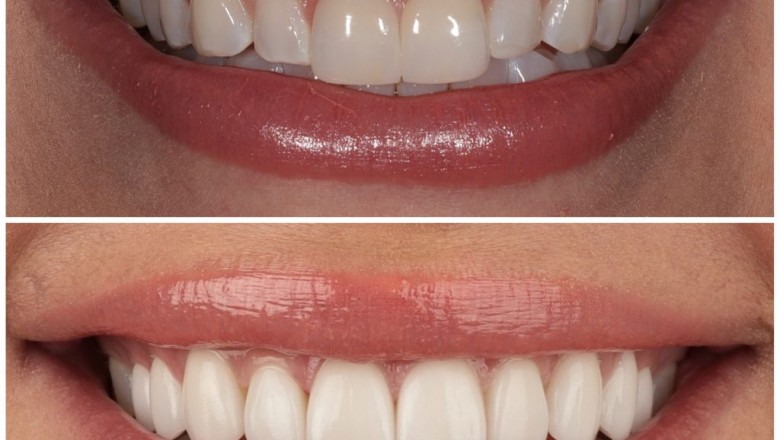 Porcelain Dental Veneers in West Hollywood at Smile Atelier
