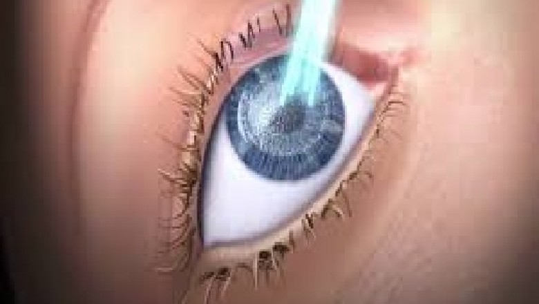 Global Excimer Laser Market Trends, Size, Forecast - 2019-2025