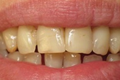 Tooth Stains | Dental Emergency in Philadelphia, 19151