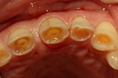 Tooth Abrasion | Dental Emergency in Upper Darby