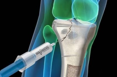 Bone Grafts and Substitutes Market Global Demand, Latest Technology and Outlook 2020 to 2030
