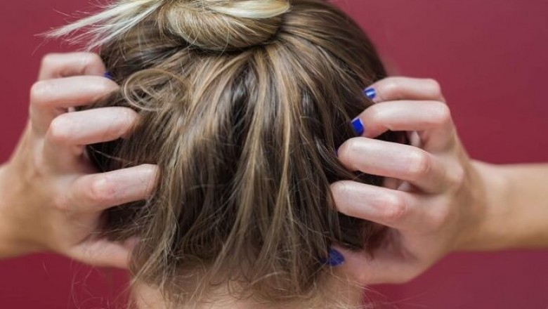 Get Rid From scratching your head, then do this remedy - Maharashtra Today